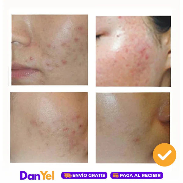 Mascarilla Antiacné - Bioaqua 2x1