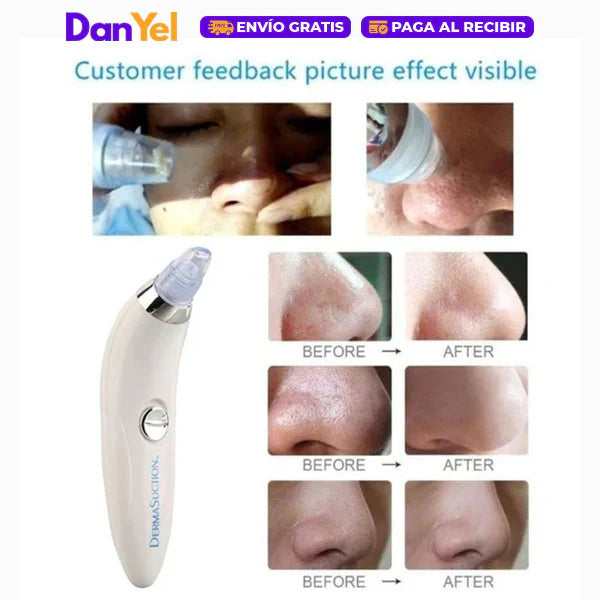 Extractor De Puntos Negros