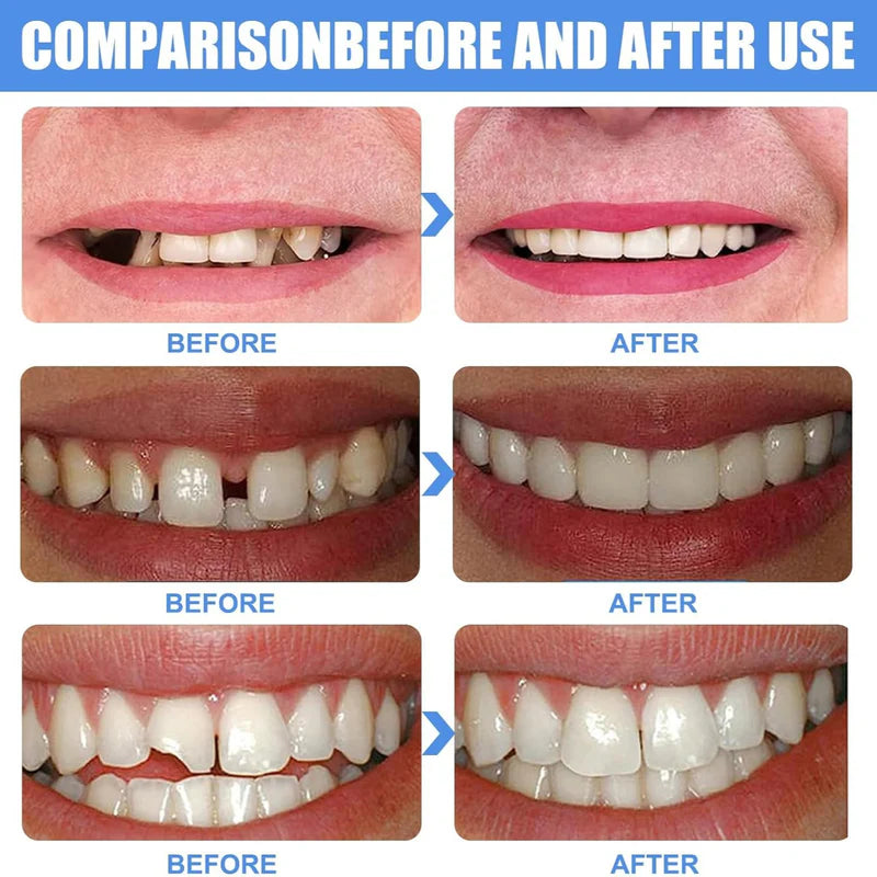 Sonrisa Perfecta Al Instante | Repara Tu Sonrisa | Implante De Diente