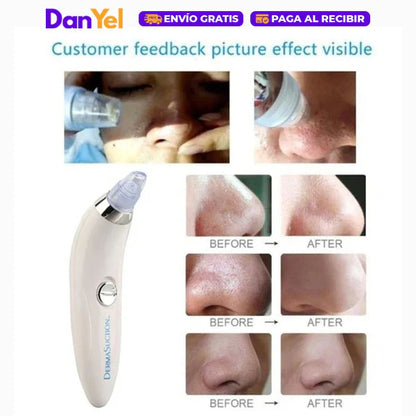 Extractor De Puntos Negros