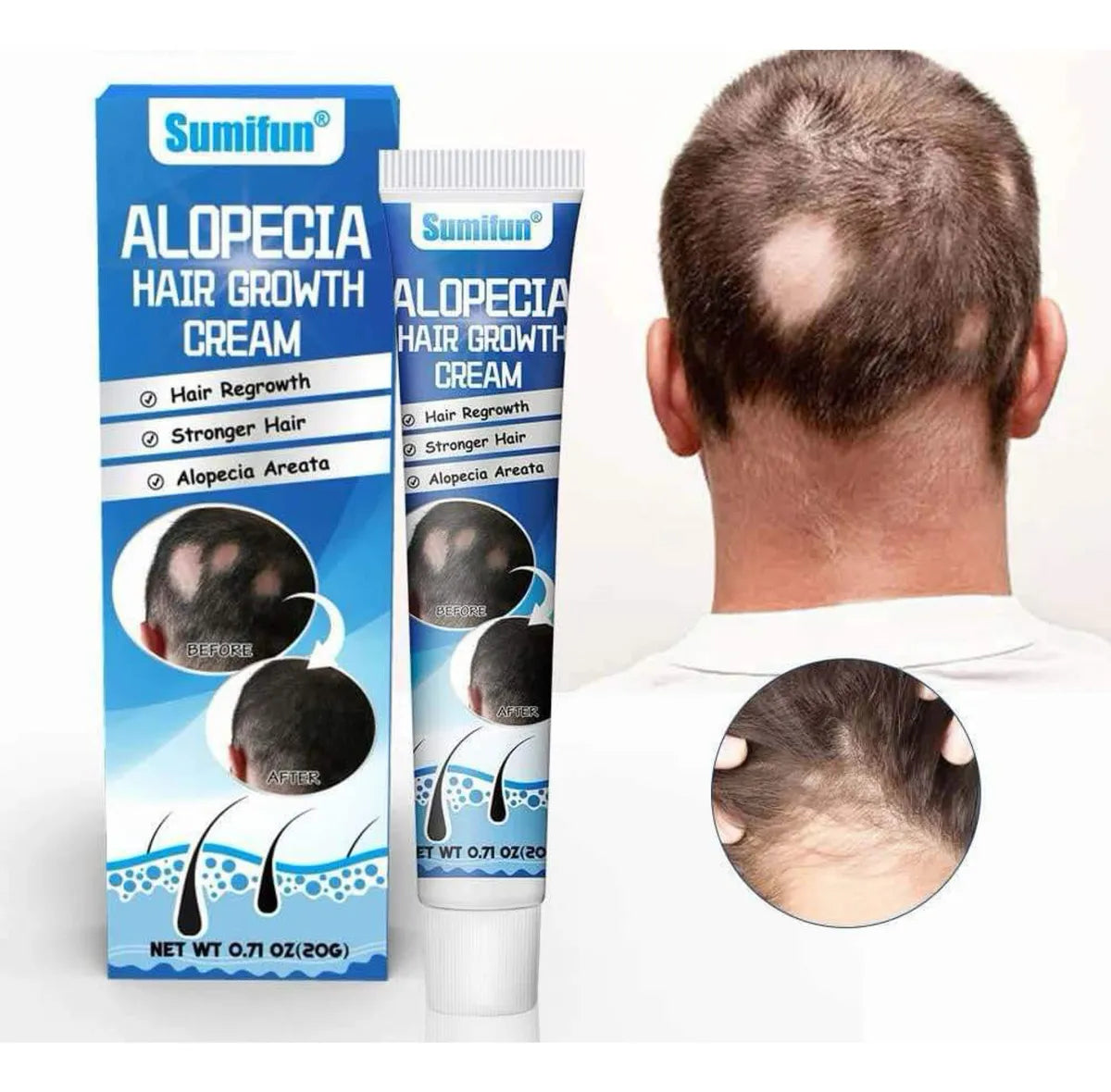 Crema para el Tratamiento de la Alopecia