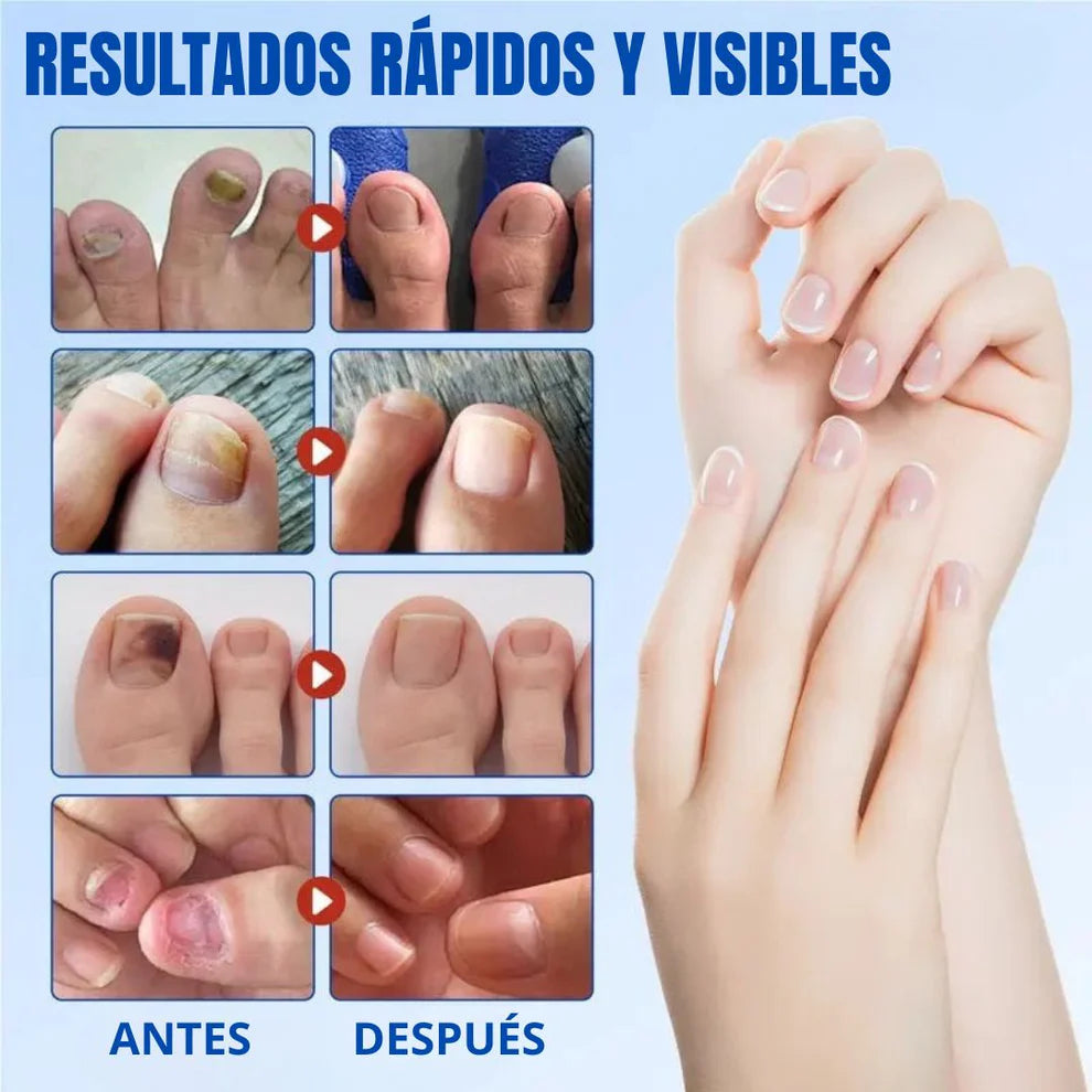 Parches Anti-Hongos para Uñas