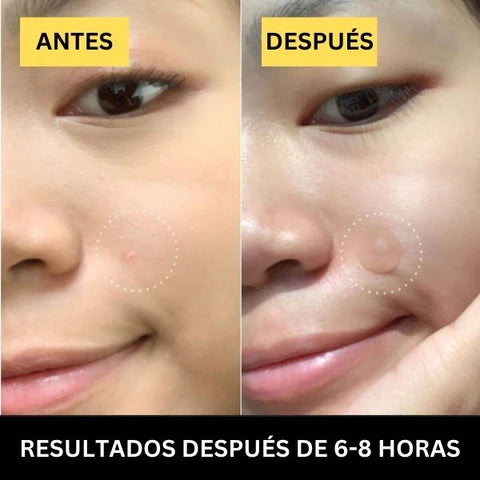 Parches para Tratamiento del Acné 2x1