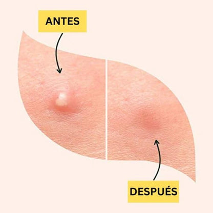 Parches para Tratamiento del Acné 2x1
