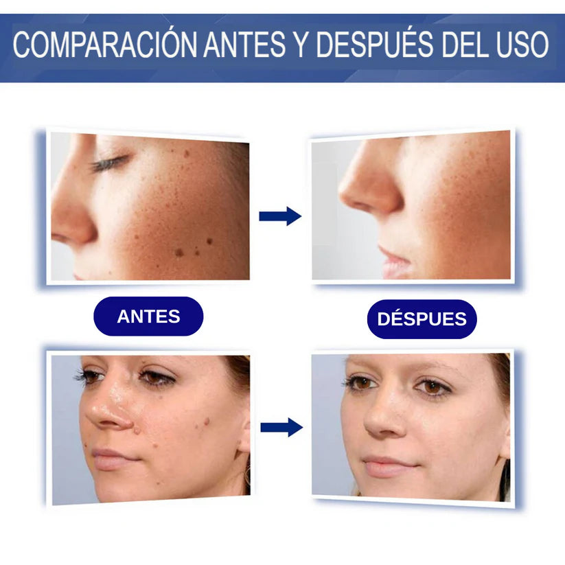 Crema para Eliminas Verrugas
