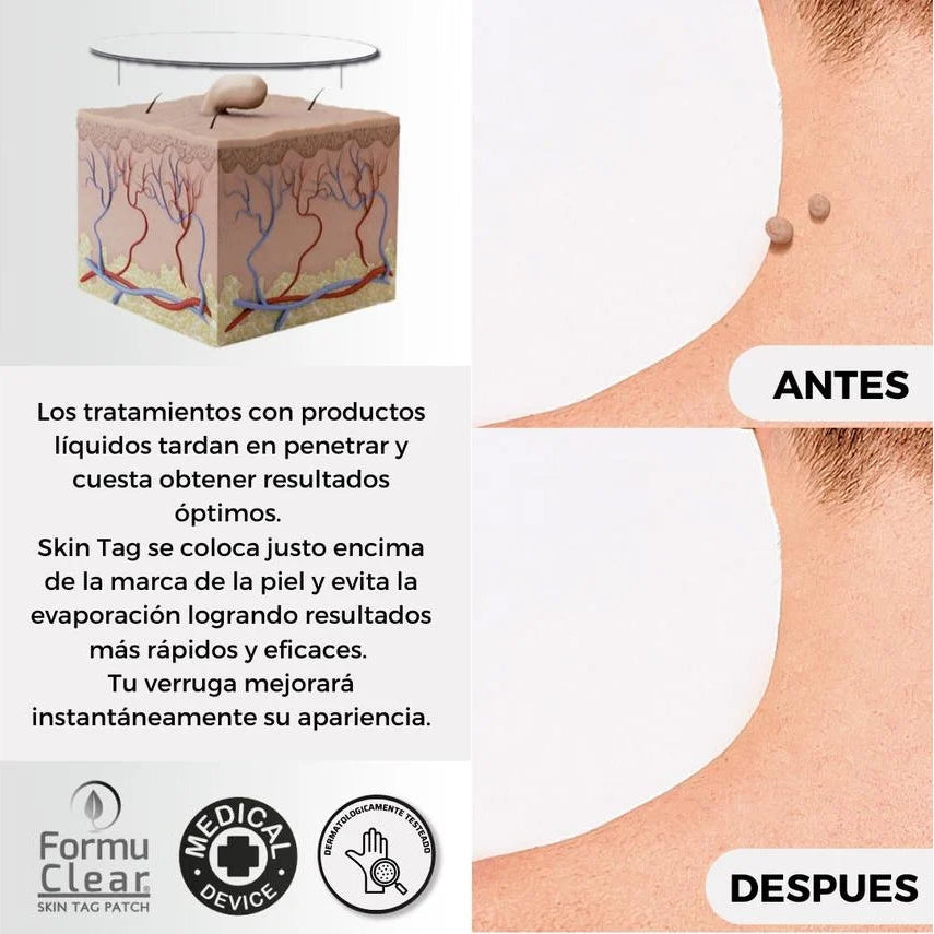 Eliminador Natural de Verrugas | Formu Clear Skin Tag Patch