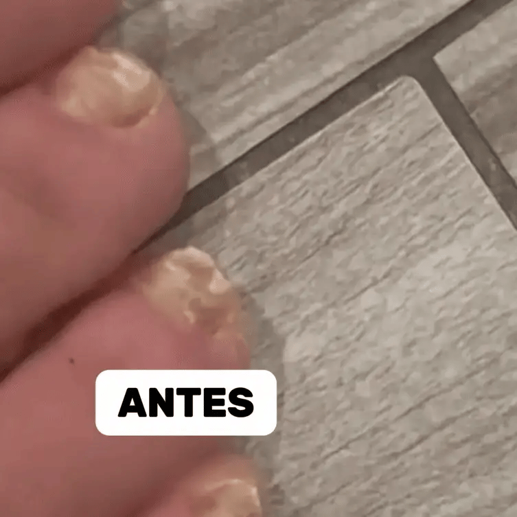 Gotas para Hongos y Uñeros | Tratamiento Rápido y Efectivo